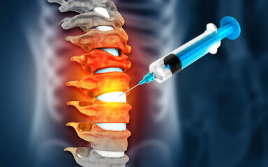 3d illustration of a lumbar spine injection - obrazy, fototapety, plakaty