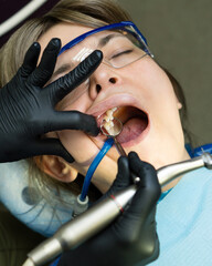 Caries treatment to chewing side tooth upper jaw © Vagengeim