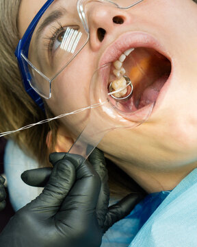Installation metal clip. Tooth restoration process