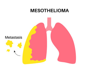 Mesothelioma cancer disease