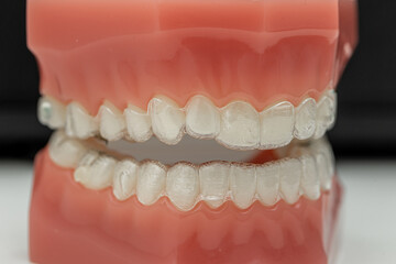 Invisible and removable aligners for teeth alignment