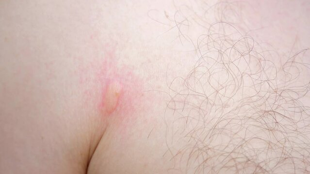 Man skin is seen to be covered in red and swollen welt, insect bite. Bite from of insects, mosquitoes, fleas, ants. Scratching and rubbing at the bites, discomfort and pain.