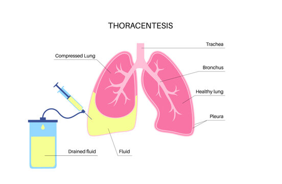 Thoracentesis medical procedure
