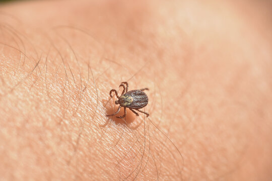Infected tick on hairy human skin. Ixodes ricinus. Parasitic mite, Encephalitis tick