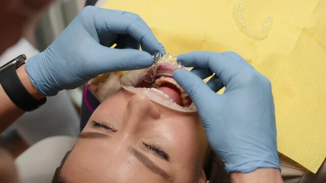 Lying on a chair. Installation of aligner. Woman in the stomatology clinic, visiting dentist.
