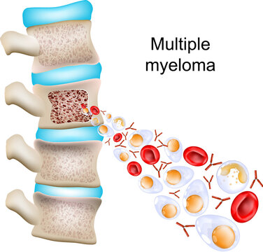 Multiple myeloma