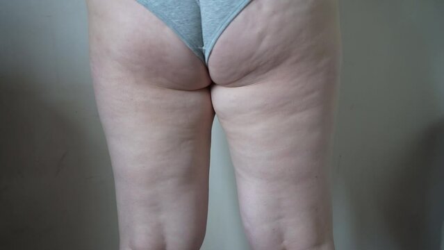Thigh of a woman with cellulite. Figure problem, cosmetic massage. An overweight girl massages her leg with her hands and checks for cellulite.