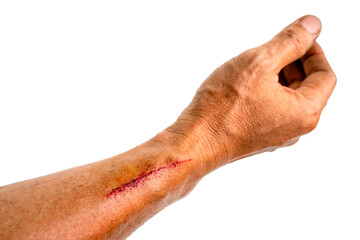 Arm injuries from work accidents on a white background