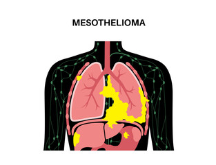 Mesothelioma cancer disease