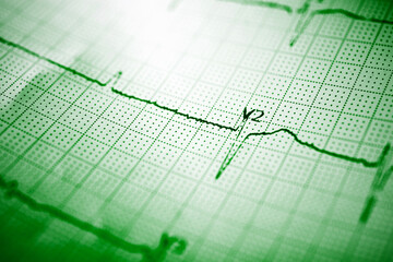 Close-up of an electrocardiogram printed on green paper.