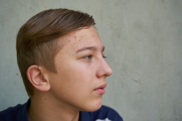 Fototapeta premium a teenager with acne on his face,portrait of a boy in profile looking with pimples on his face