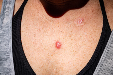 Young female 30s close up of chest prior to applying imiquimod cream medication to basal cell...