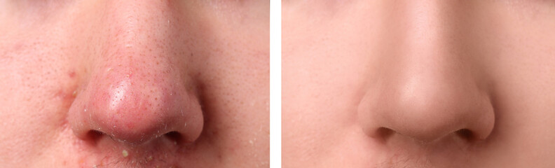 Fototapeta premium Photos of man before and after acne treatment, closeup. Collage showing affected and healthy skin