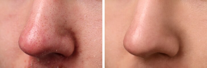 Photos of man before and after acne treatment, closeup. Collage showing affected and healthy skin