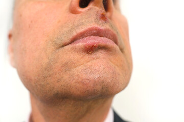 close up part of mature male face, man, senior 60 years old looks carefully examines herpes on lip, under nose, viral disease with specific blisters (vesicles) on skin