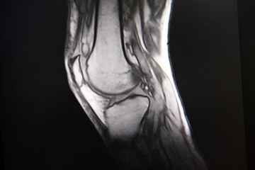 Längsschnitt durch ein Kniegelenk im MRT - Gut erkennbar sind die Kniescheibe und der darunter...