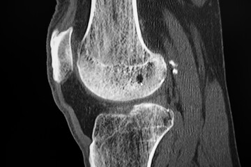 CT Aufnahme eines linken Kniegelenks mit gut erkennbarer Knochenzyste im Oberschenkelknochen, sowie...