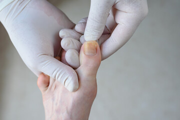 Onychomycosis. Foots with fungus on nails is examined by doctor in gloves - obrazy, fototapety, plakaty
