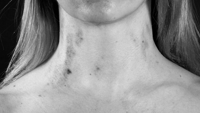Women's neck: traces of violence. Black and white photo