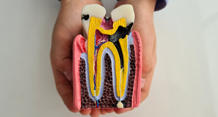 Child holds model of tooth with caries closeup