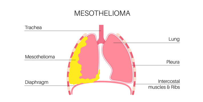 Mesothelioma cancer disease