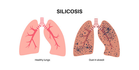 Obraz premium Silicosis dust in lung