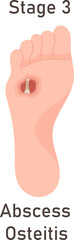 Abscess Osteitis Foot Disease