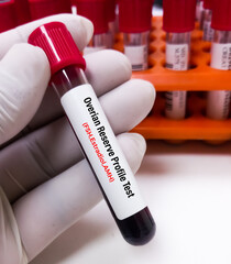 Blood sample for Ovarian Reserve Test, ORT is a test combination of FSH Estradiol, AMH...