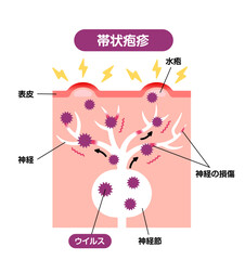 帯状疱疹の発生メカニズム / 皮膚断面図 図解イラスト