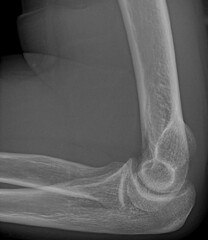 röntgenbild arzt krankenhaus unfall diagnose langzeit wirkung krankschrebung verunfallt arm...