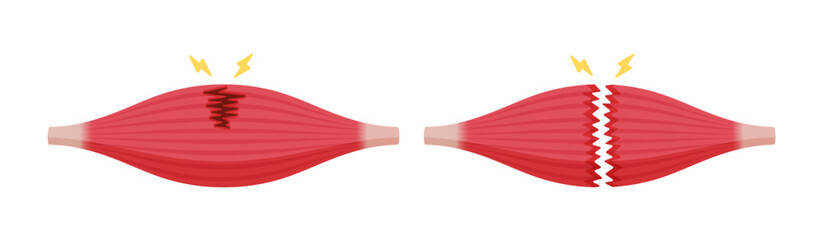 Muscle rupture vector illustration (partial and complete tears )