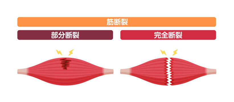 筋断裂 (肉離れ) の症状 ベクターイラスト (部分断裂・完全断裂) Stock Vector | Adobe Stock