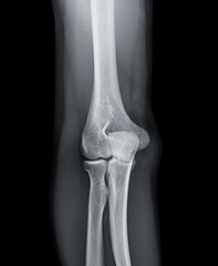 X-ray of Elbow joint  Front view.