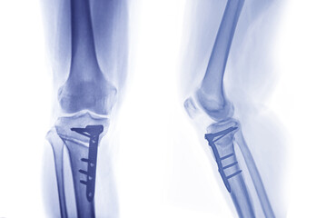 x-ray image of  Right knee  AP and Lateral view showing Total knee arthroplasty and fractures of the tibial plateau with plate and screw fixation.