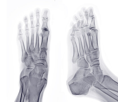 Foot x-ray image AP and Oblique  view  isolated on white background.