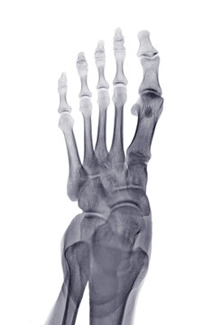 Foot x-ray image AP iew  isolated on White  background.