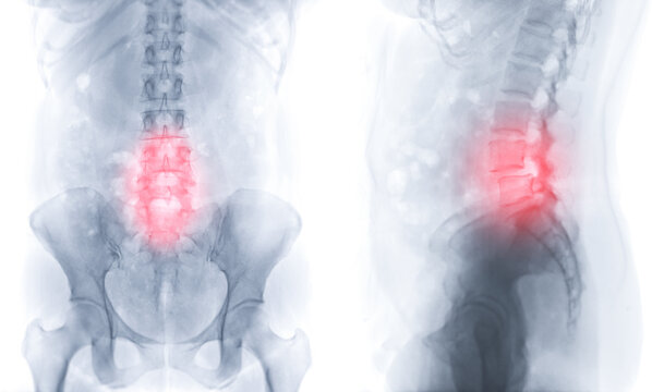 X-ray image of lumbar Spine  or L-s spine AP and lateral view for diagnosis lower back pain.