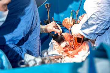 Close-up of the hands of surgeons during an operation on the open abdomen of a patient, sterile medical instruments, teamwork