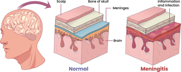illustration of meningitis, inflammation membranes covering the brain - obrazy, fototapety, plakaty