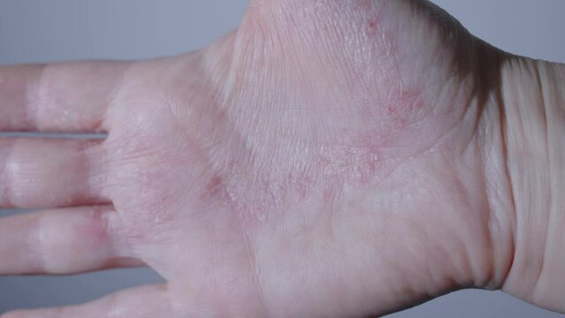 dermatology dry skin eczema disease psoriasis itchy epidermis palm hand. dermatitis disease itchy scratch ugly skin condition allergic reaction food sweet unhealthy lifestyle. diet problem close-up 
