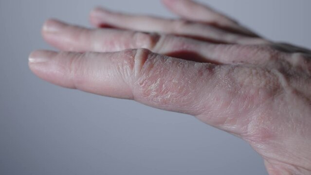 dermatology dry skin eczema disease psoriasis itchy epidermis palm hand. dermatitis disease itchy scratch ugly skin condition allergic reaction food sweet unhealthy lifestyle. diet problem close-up 