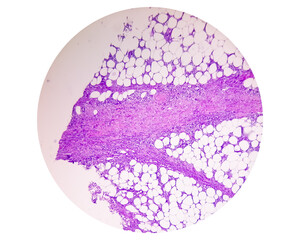 Photomicrograph of granulomatous tissue histology showing Foreign body granuloma.
