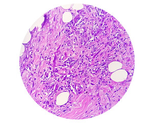 Photomicrograph of granulomatous tissue histology showing Foreign body granuloma.