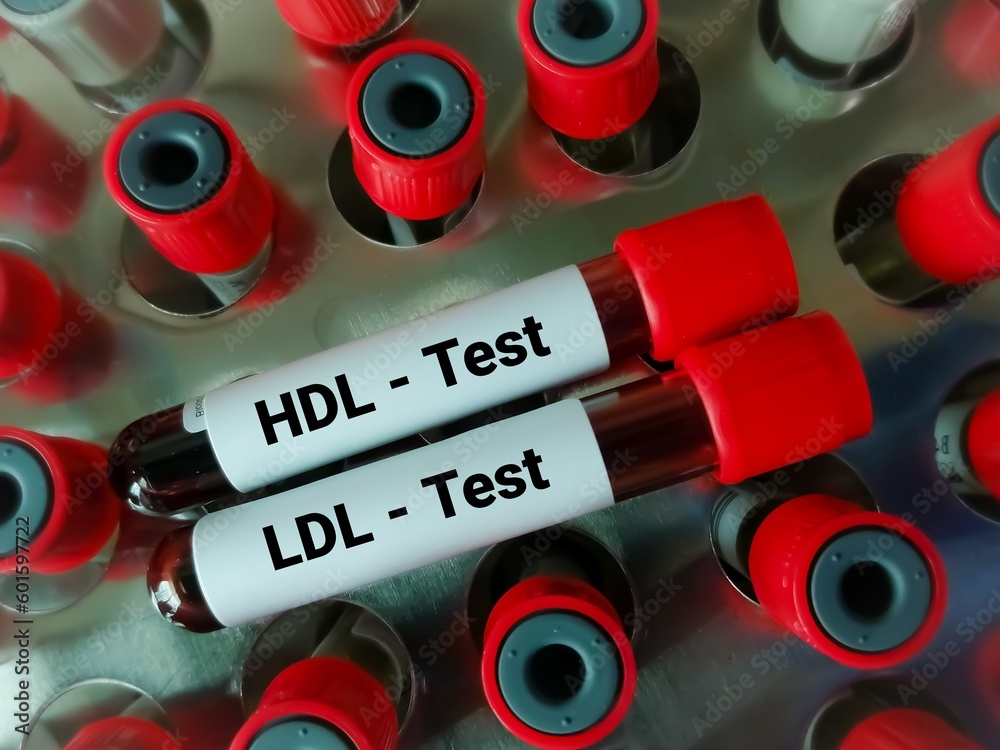 Poster Blood samples isolated for HDL Cholesterol (good cholesterol) and LDL Cholesterol (bad cholesterol) test, Cardiovascular disease diagnosis.