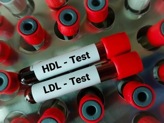 Blood samples isolated for HDL Cholesterol (good cholesterol) and LDL Cholesterol (bad cholesterol) test, Cardiovascular disease diagnosis.