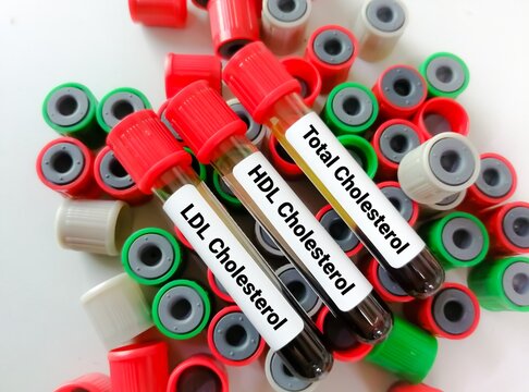 Blood samples isolated for Total Cholesterol testing, HDL Cholesterol and LDL Cholesterol test, Lipid profile. Cardiovascular disease diagnosis.