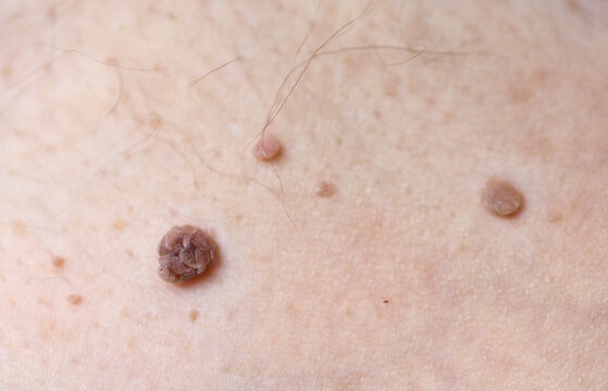 Nevus close-up. Mole on human skin. Irregular birthmark.