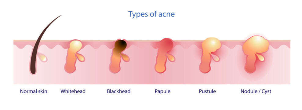 Types of acne vector isolated on white background. Formation of normal skin, acne, pimple, comedone, non inflammation acne, whitehead, blackhead, inflammation acne, papule, pustule, nodule and cyst. 