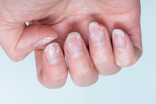 Brittle Nails | The Woodruff Institute
