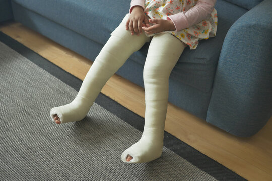 little child with plaster bandage on leg.